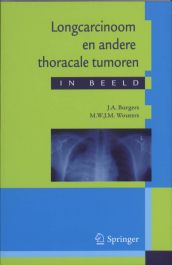 BSL Shop | Longcarcinoom en andere thoracale tumoren in beeld